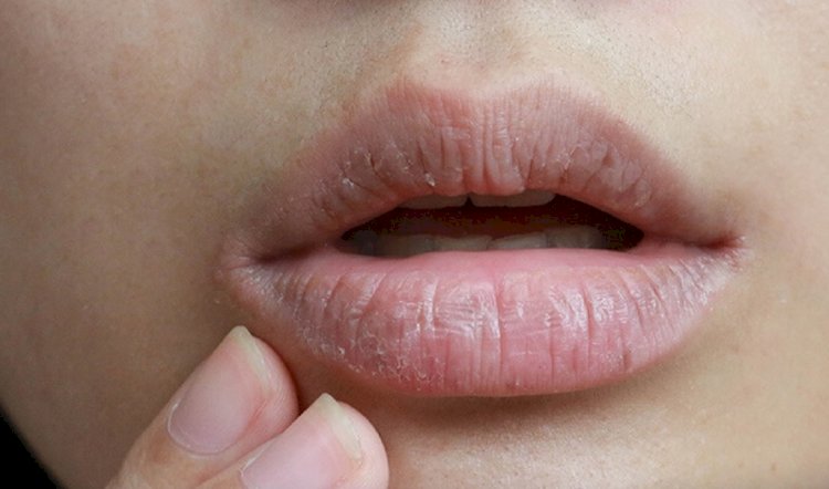 الجفاف حول الفم مشكلة تؤرق المرأة في كل الاعمار