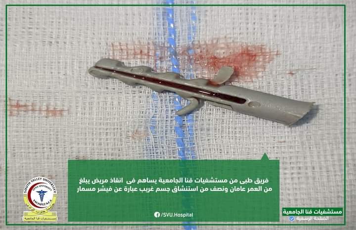 المستشفى الجامعي بقنا تنقذ رضيعًا استنشق فيشر مسمار