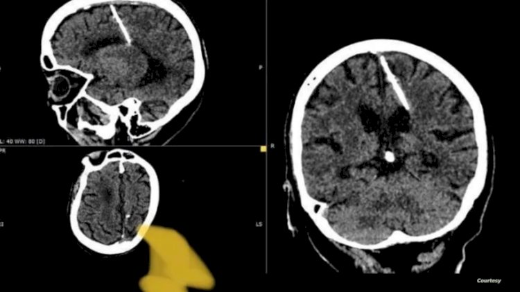 اكتشاف إبرة طولها 13 سم عمرها 80 سنه في دماغ عجوز روسية