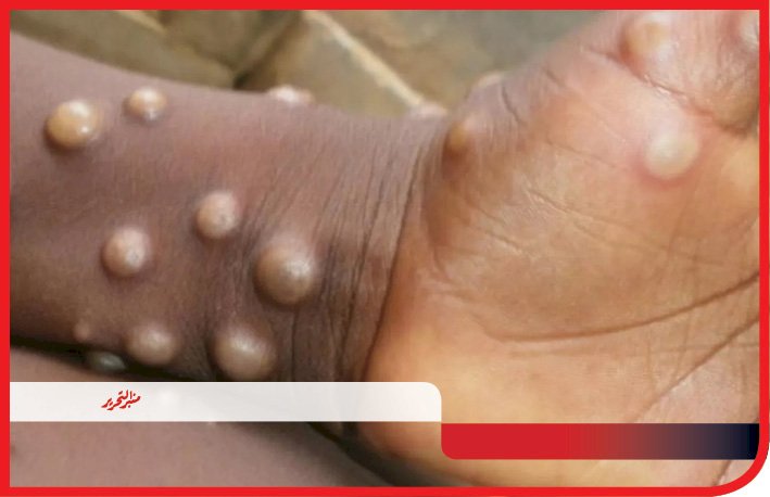 مفاجأة : أمريكا احتجزت ملايين لقاحات علاج جدري القرود ومنعته عن أفريقيا