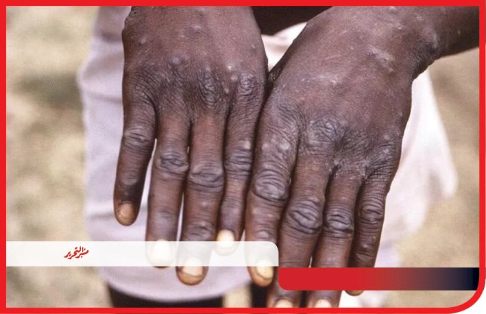 رغم عدم دخوله مصر حتي الآن.. بيزنس جديري القرود علي كل لون