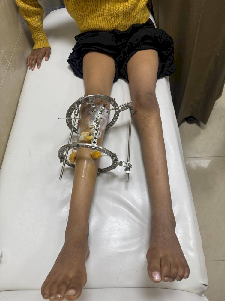 جراحات تشوهات وعظام الأطفال بحورس  تستعدل حالة تقوس مرض بلاونت