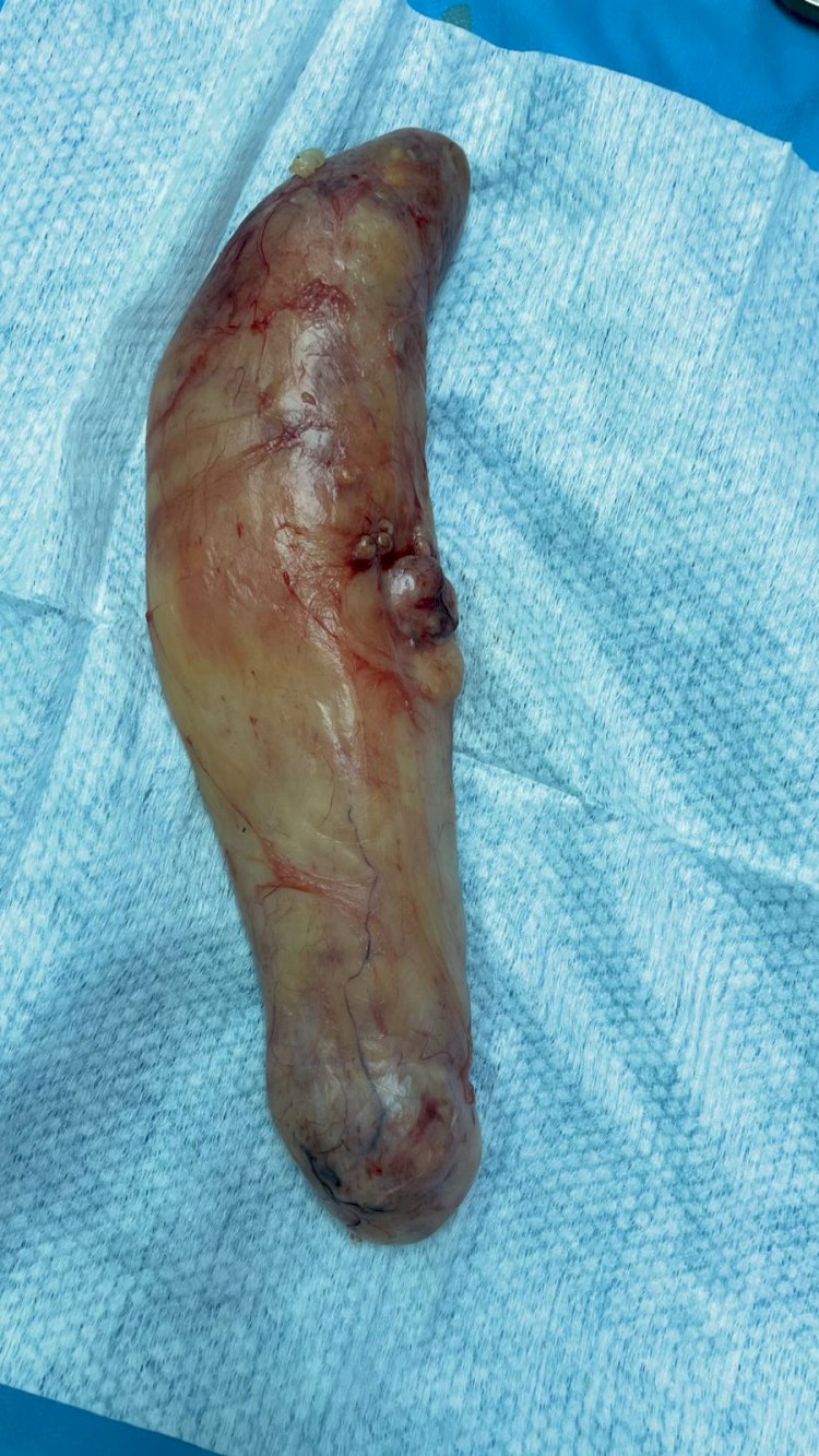 فريق طبى بمستشفى سوهاج الجامعي ينجح في استخراج ورم نادر بالساق يزن 1.5 كجم