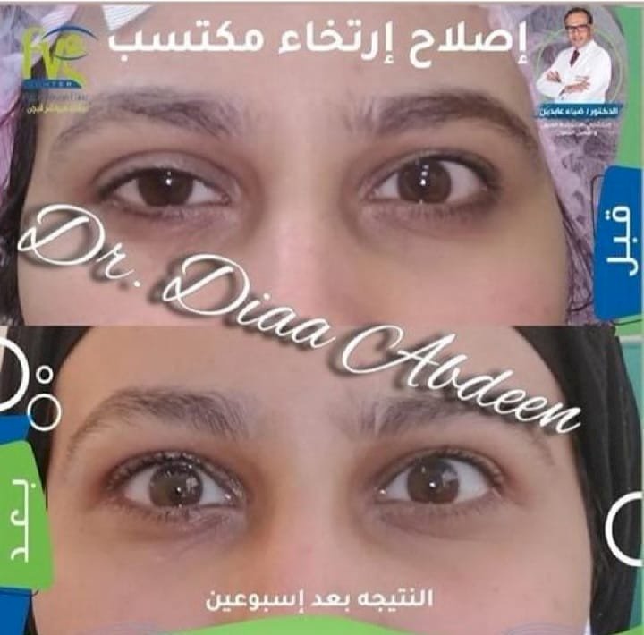 د. ضياء عابدين يحذر: ارتخاء الجفون وكسل العين خطر صامت يهدد الأطفال والكبار