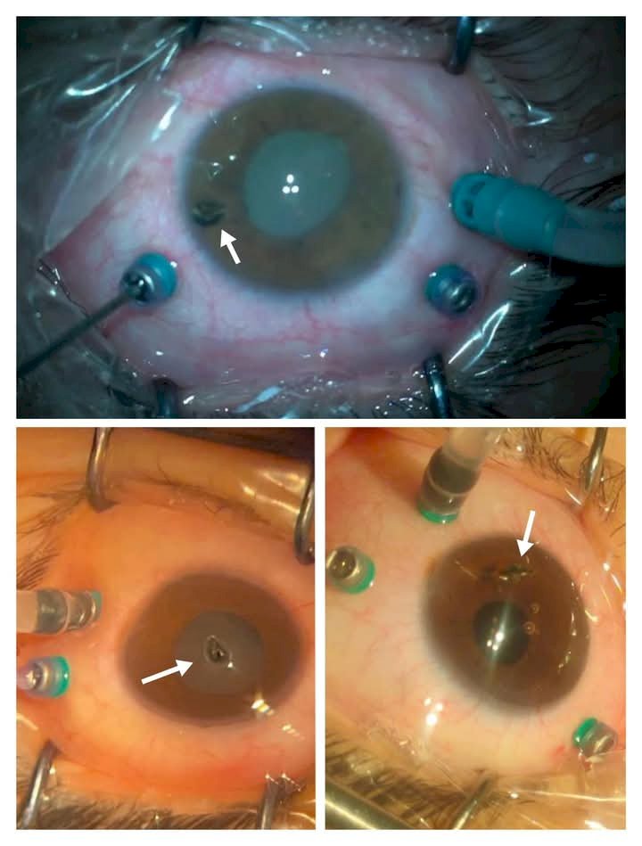 مستشفى كفر الشيخ الجامعى تنجح في إنقاذ ثلاث حالات من فقدان البصر