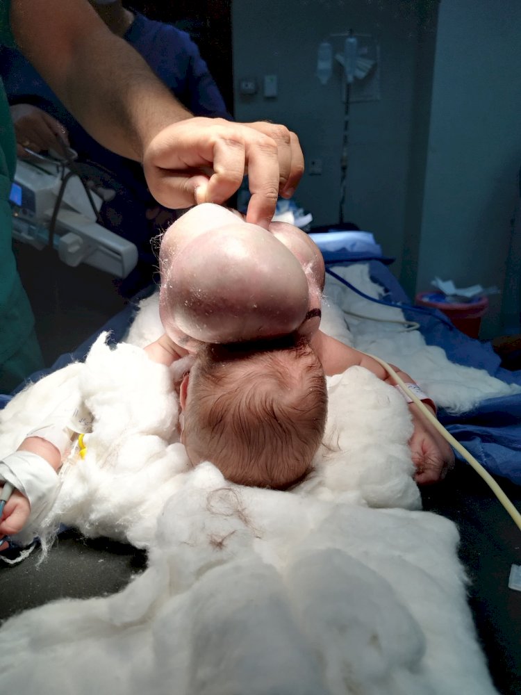 إجراء عملية جراحية فتق دماغى لطفلة بعد ولادتها  مباشرة