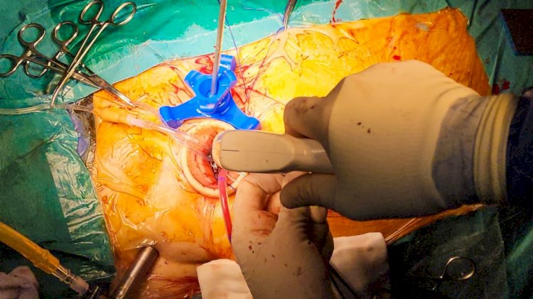 مستشفى كفر الشيخ الجامعي يُجري أول عملية لتغيير الصمام المترالي بالمنظار