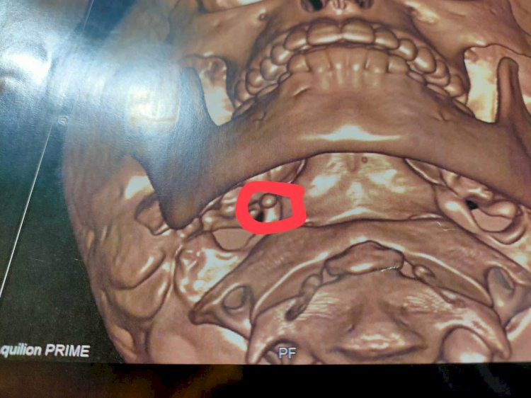 نجاح استئصال غدة لطفل 11 عامًا بمستشفى قنا العام ضمن جهود تطوير المنظومة الصحية